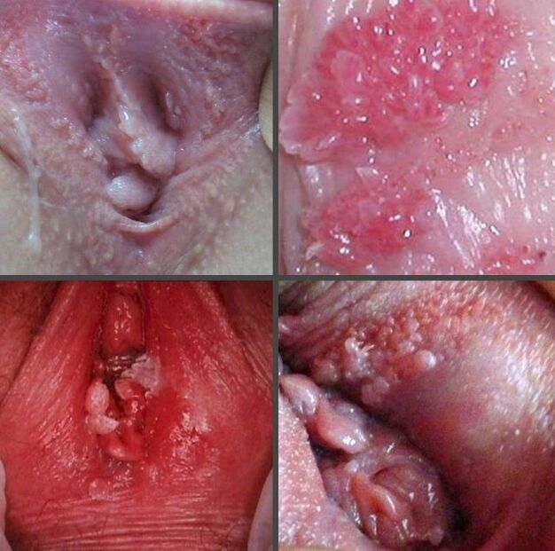 Cerca de un papiloma en la vagina