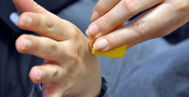 eliminación de la verruga en la mano