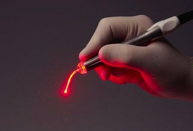 laser para papiloma de garganta