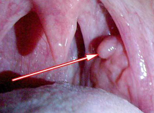 Papiloma de laringe