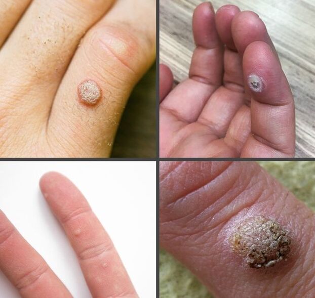 Tipos comunes de verrugas en los dedos